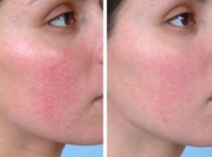 Fonte: https://mejorconsalud.com/tratamiento-recomendaciones-combatir-la-rosacea/ 